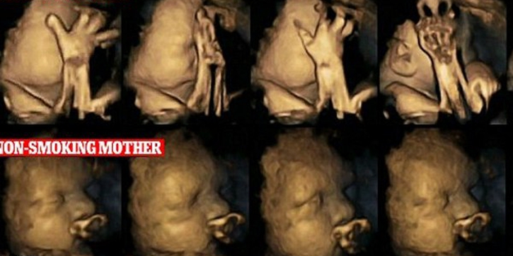 Hasil USG Bayi dengan Ibu Perokok