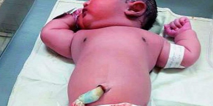 Ibu Diabetes Lahirkan Bayi 6 Kilogram