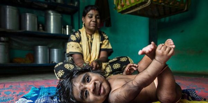 Kelainan Genetis, Bayi ini Jadi Werewolf