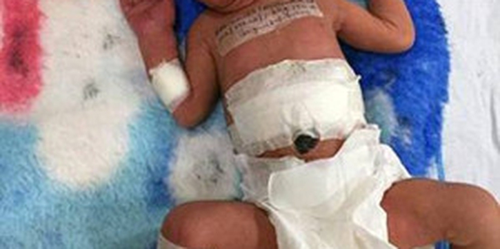 Bayi dengan Kembar Parasit Berhasil Dioperasi