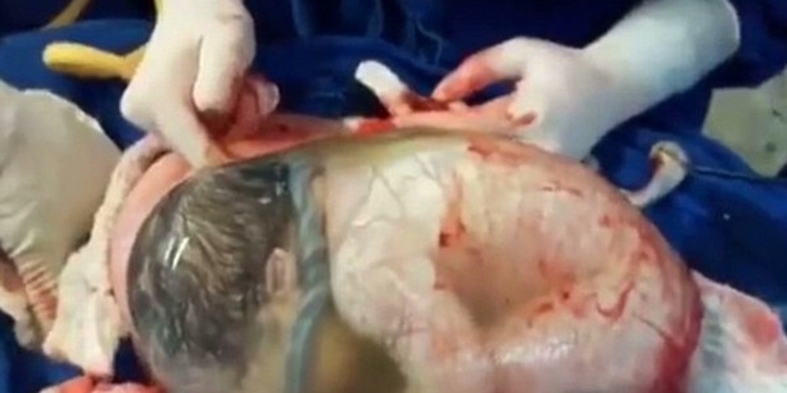 Bayi Ini Lahir Masih Terbungkus Kantung Ketuban!