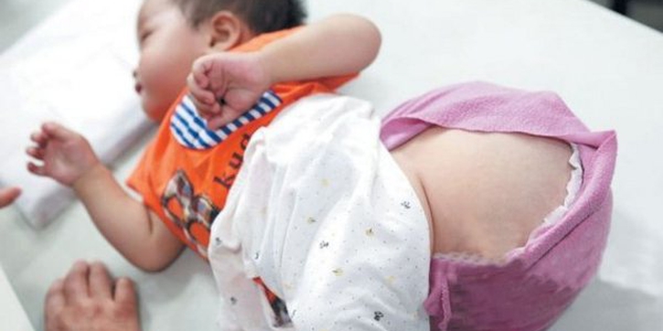 Anak Menderita Tumor Sebesar Melon 