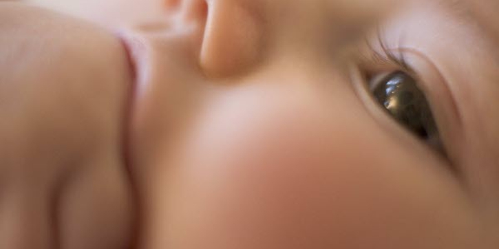 Infeksi Impetigo di Kulit Si Kecil
