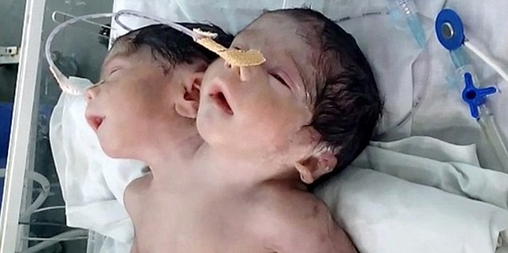 Bayi Berkepala 2 Ini Hanya Bertahan Hidup 32 Jam