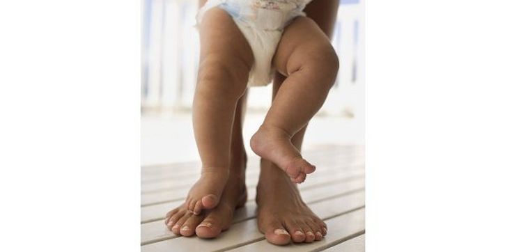 Kelainan Bentuk Kaki Bayi (2)