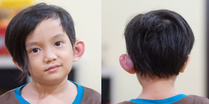 Anak Musisi Anji, Saga, Terkena Sinus Preauricular
