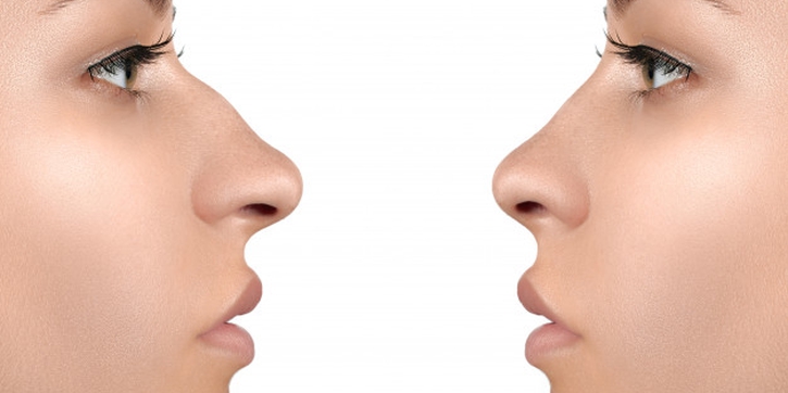 Rhynoplasty, Cara Memancungkan Hidung yang Efektif dan Aman