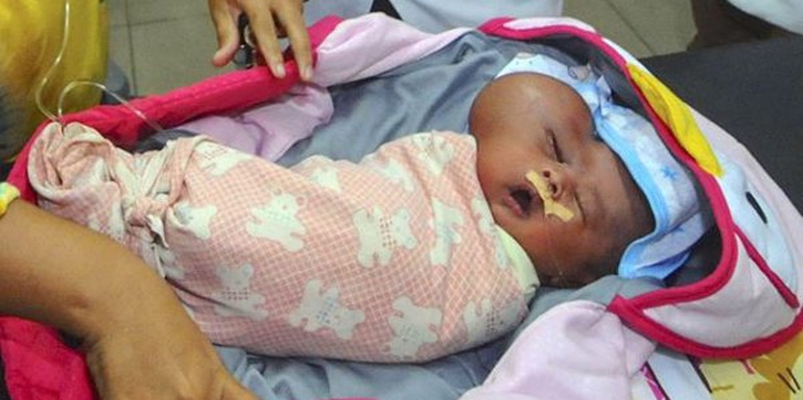 Bayi Lahir dengan Kepala Berbentuk Hati