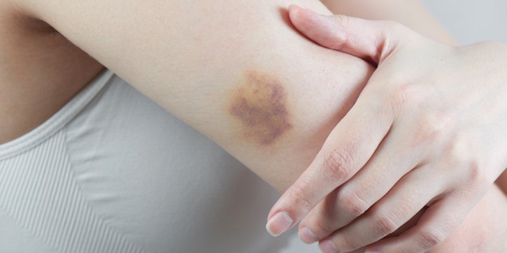 Tubuh Mudah Memar? Kenali 7 Tanda Kekurangan Vitamin K