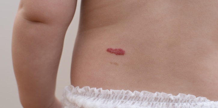Waspada Hemangioma, Gumpalan Merah pada Tubuh Bayi