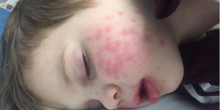 Sering Dicium, Balita Terjangkit Herpes dan Nyaris Buta
