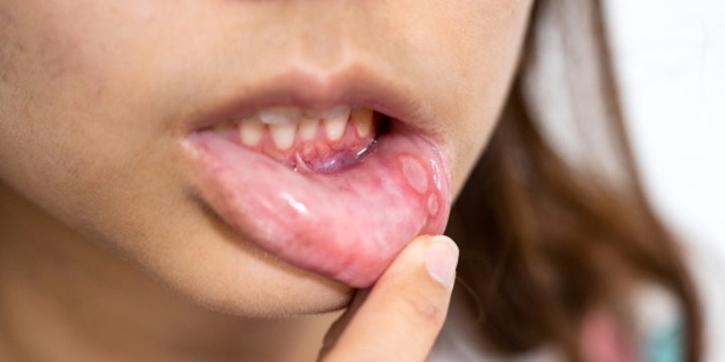 Mengenal Kandidiasis, Infeksi Jamur pada Kulit, Mulut, dan Vagina