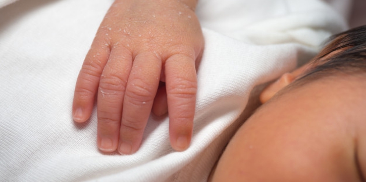 Kulit Bayi Baru Lahir Mengelupas, Ini Penyebab dan Cara Atasinya