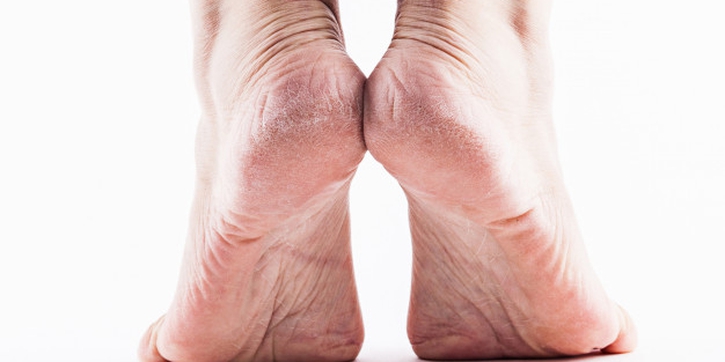Moms, Ini Cara Tepat Tangani Kulit Kaki Pecah-pecah