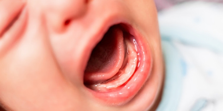 Lidah Bayi Putih? Ini Penyebab dan Cara Mengatasinya