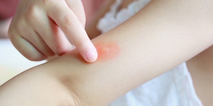 Anak Sering Bentol karena Darah Manis? Ini Penyebab dan Solusinya
