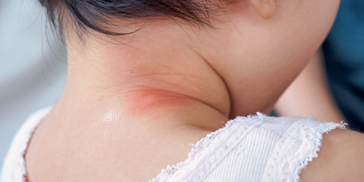 Ini 5 Penyebab Ruam di Leher Bayi dan Cara Mengatasinya