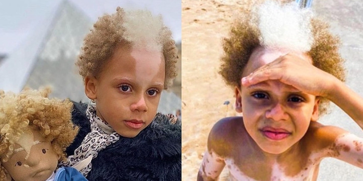Viral! Supermodel Cilik dengan Kelainan Piebaldism