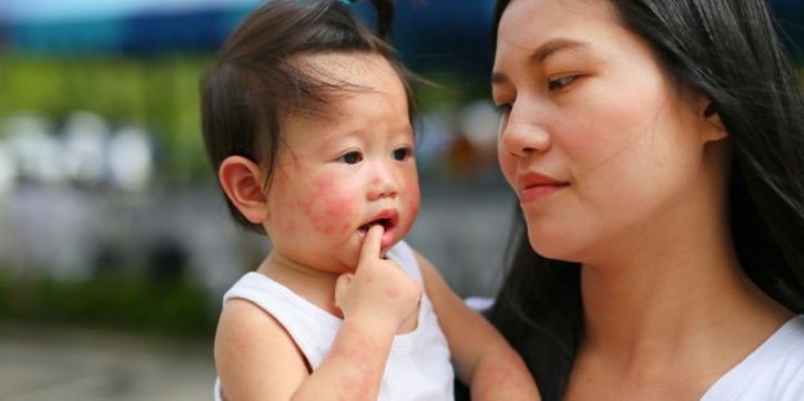 Ini Masalah Kulit yang Sering Dialami oleh Bayi