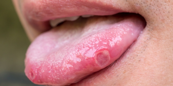 Covid Tongue, Gejala COVID-19 yang Mirip Sariawan