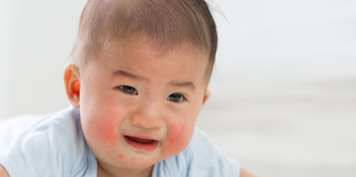 Mengenal Selulitis, Infeksi Bakteri yang Serang Kulit Bayi