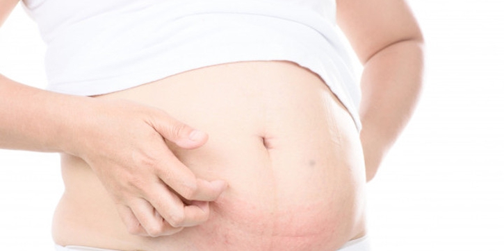 Serba-serbi Stretch Mark yang Perlu Anda Tahu