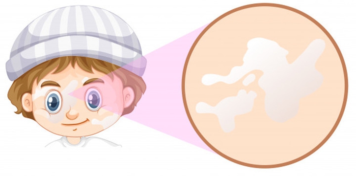 Kenali Serba-Serbi Vitiligo yang Terjadi pada Bayi