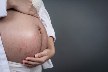 Rahasia Merawat Stretch Marks dengan Perawatan Kulit yang Tepat