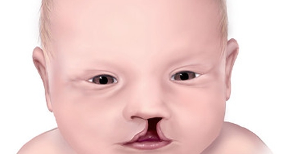 Penyebab Bibir Sumbing pada Anak, bisa Karena Makeup!