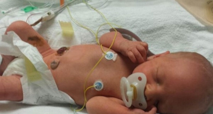 Bayi Lahir Dengan Gastroschisis