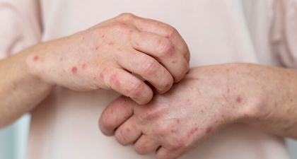 Kasus Meningkat, Waspadai Mpox atau Cacar Monyet, Ini Gejala dan Pencegahannya