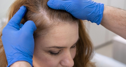 8 Penyebab Kebotakan Rambut yang Terjadi pada Pria dan Wanita