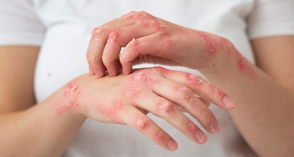 Duh Ngeri, Deretan Penyakit Kulit Ini Mudah Menular, Lho