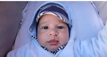 5 Penyebab Bibir Sumbing pada Bayi, Cegah Risikonya!