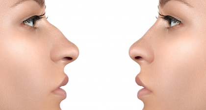 Rhynoplasty, Cara Memancungkan Hidung yang Efektif dan Aman