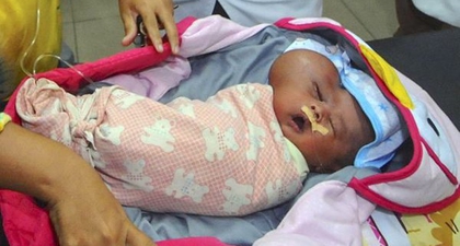 Bayi Lahir dengan Kepala Berbentuk Hati
