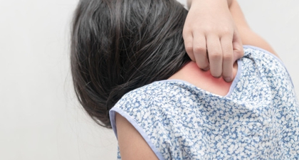 Herpes Zoster pada Anak, Serupa Tapi Tak Sama dengan Cacar Air