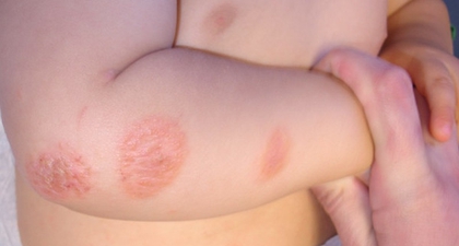 Penyakit Ringworm pada Bayi dan Cara Mengatasinya