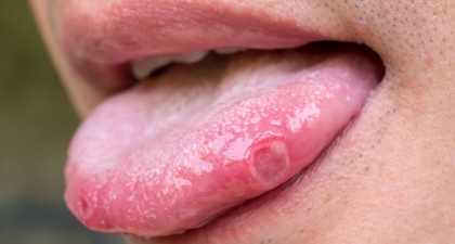 Covid Tongue, Gejala COVID-19 yang Mirip Sariawan