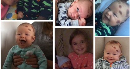 Banyak Tahi Lalat di Tubuh Bayi, Bahayakah?