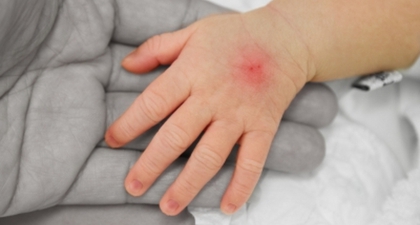 Mengenal Septicaemia (2)