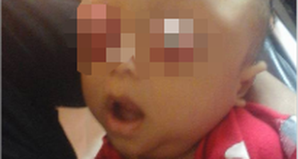 Bayi Asal Lampung Terserang Tumor Mata