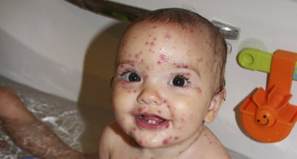 Cacar Air pada Bayi
