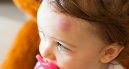 5 Langkah Ampuh untuk Mengatasi Benjol pada Bayi