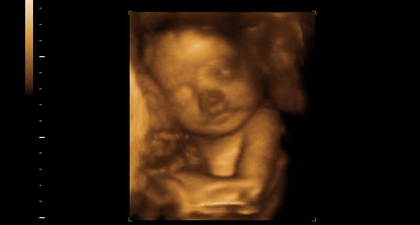  Perlukah USG 3D dan 4D?