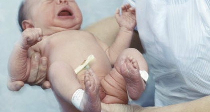 Waspada Hipotiroid pada Bayi