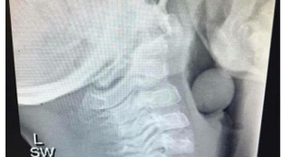 Waspada! Buah Anggur Berisiko Bikin Anak Tersedak