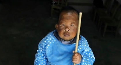 Pria Ini Tampak Seperti Balita karena Penyakit Aneh