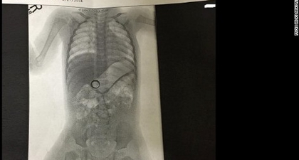 Sebuah Cincin Kawin Ditemukan di dalam Usus Bayi