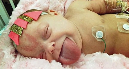Bayi Berlidah Besar Ini Akhirnya Bisa Tersenyum